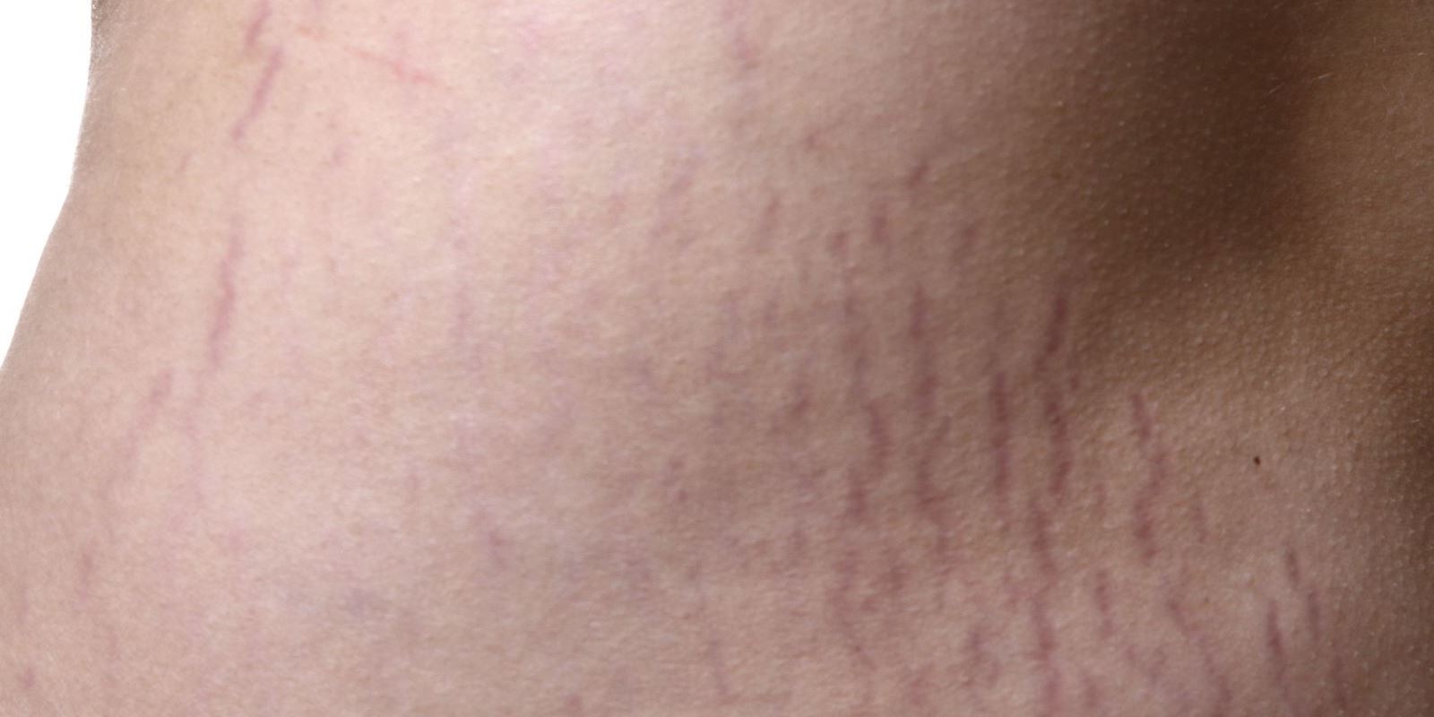 What is stretch marks and how does it occur?